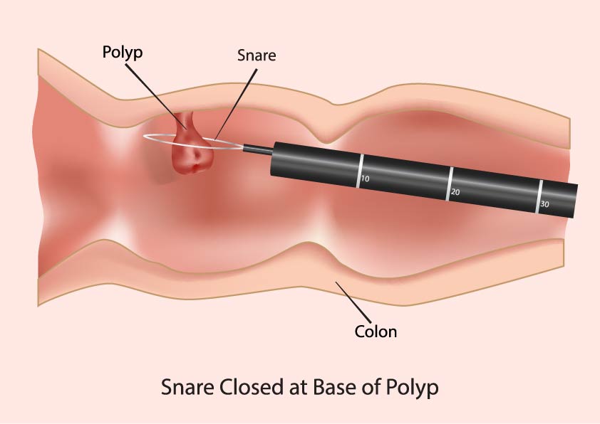 Polyp image