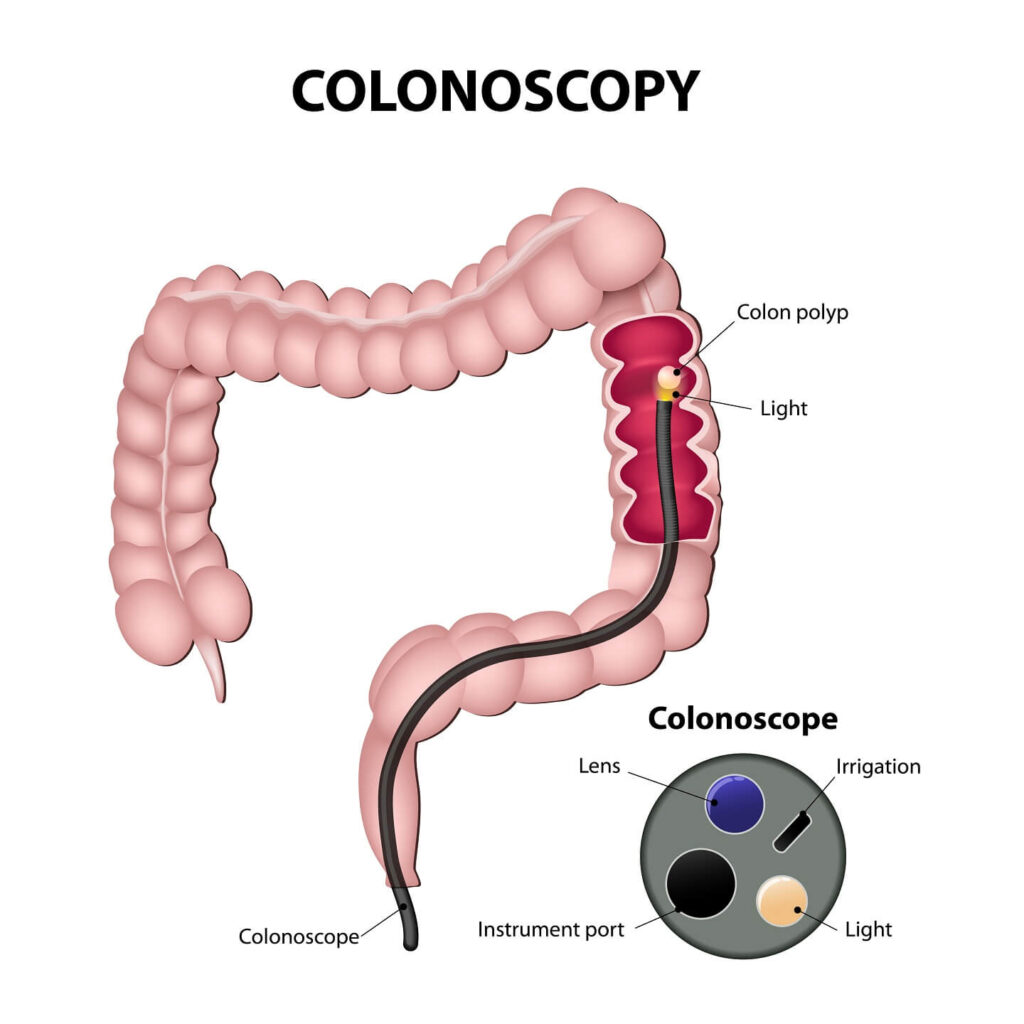 colonoscopy pic